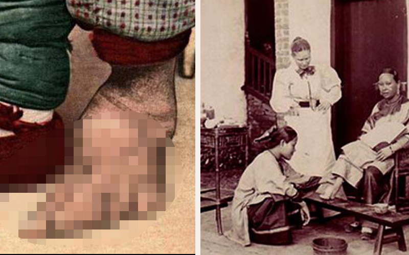 中國女人裹小腳照片曝光  十個趾頭都扭曲併攏，形狀模糊  畫面太令人震驚